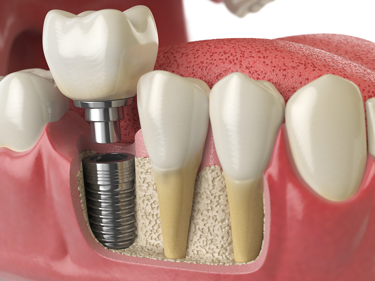 Tschuss Zahnimplantate Zahnarzt Lasst In Nur 9 Wochen Neue Zahne Wachsen