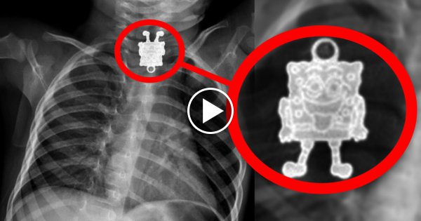10 Seltsame Gegenstände die im Menschlichen Körper gefunden wurden!