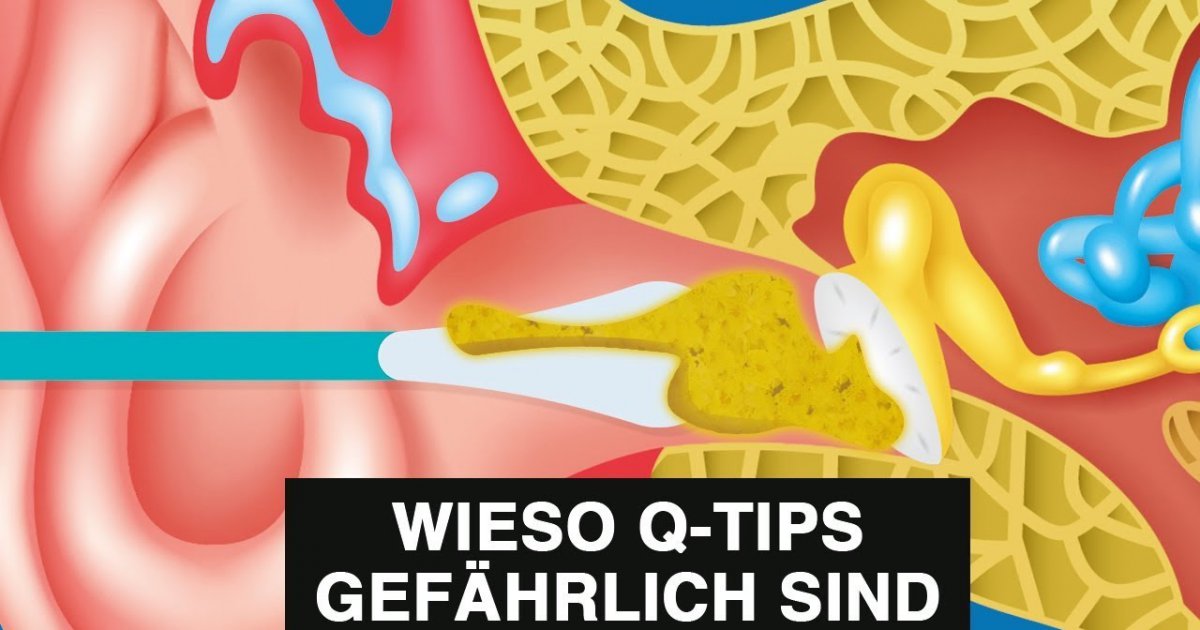 Wieso Wattestäbchen gefährlich für deine OHREN sind ?